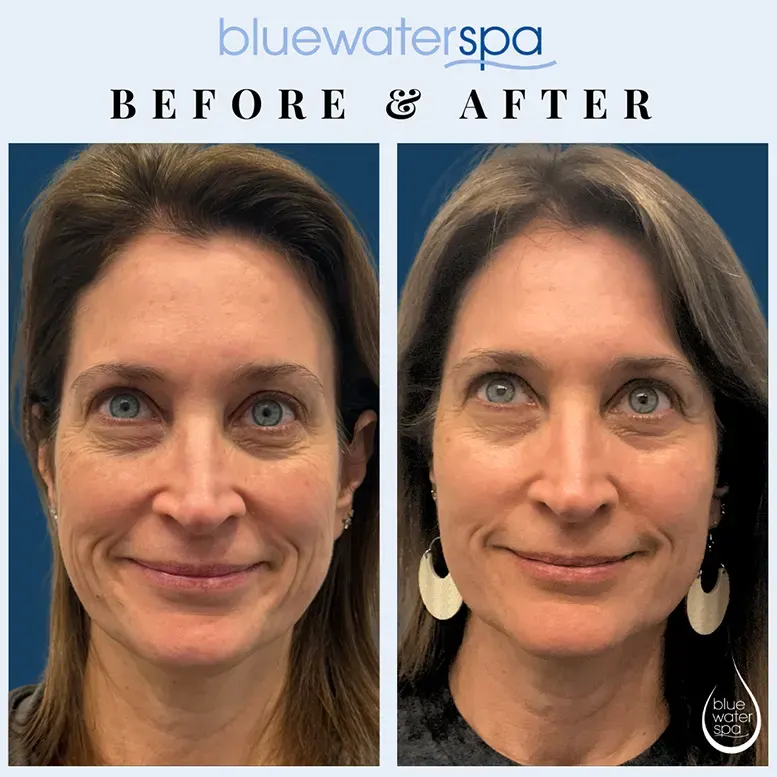 Sculptra Before & After