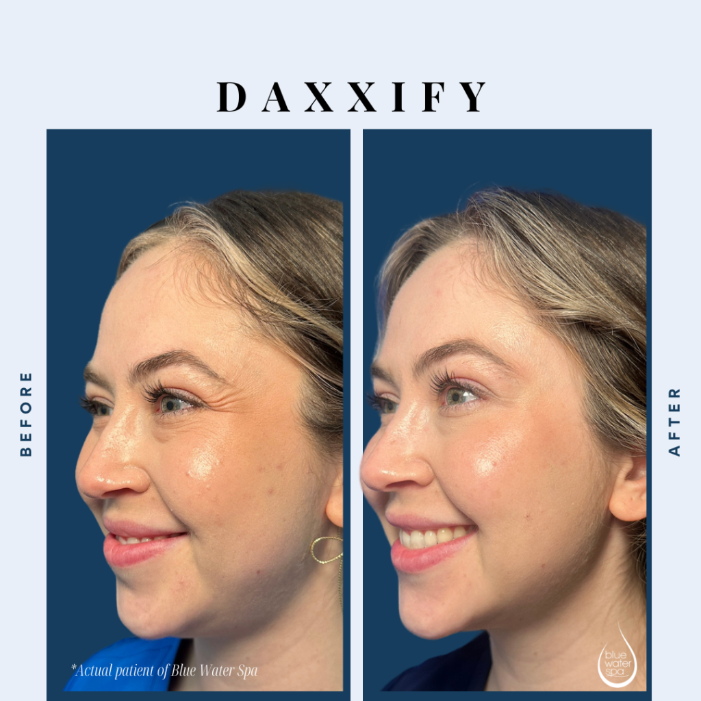 Daxxify Injections