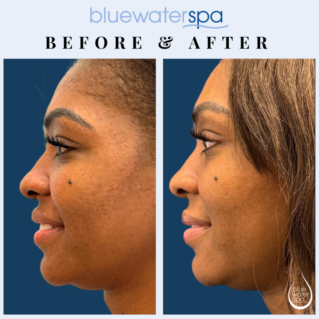 Microinfusion Facial - Before and After