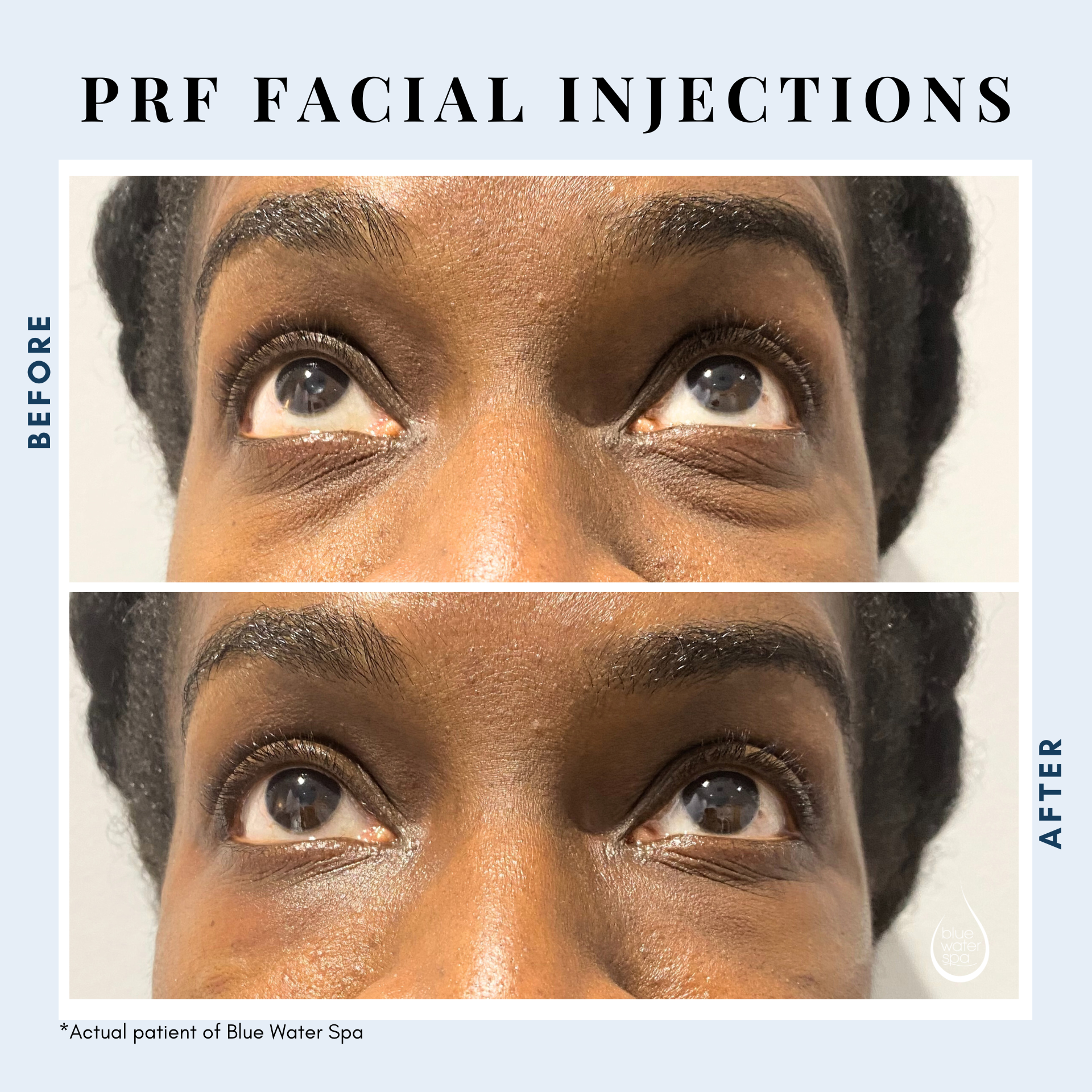 PRF  Injections for the face