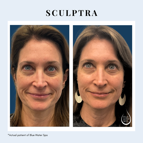 sculptra  Injections
