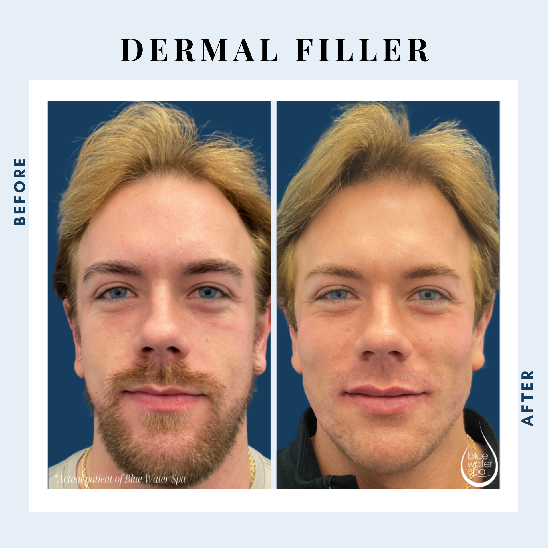 Dermal fillers