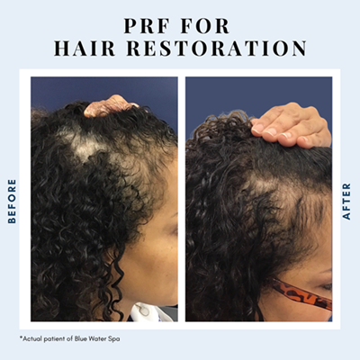 PRF Injections for the scalp